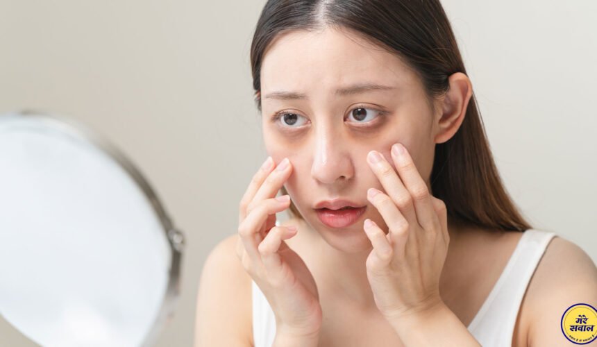 आँखों के नीचे काले घेरे (डार्क सर्कल) हटाने के लिए घरेलू उपाय ?